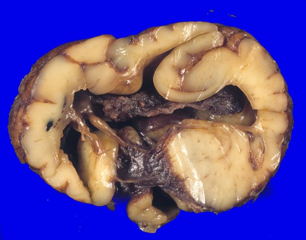 14A2-Encephalocoele-Case-14-2