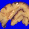 14A3 Encephalocoele (Case 14) 1