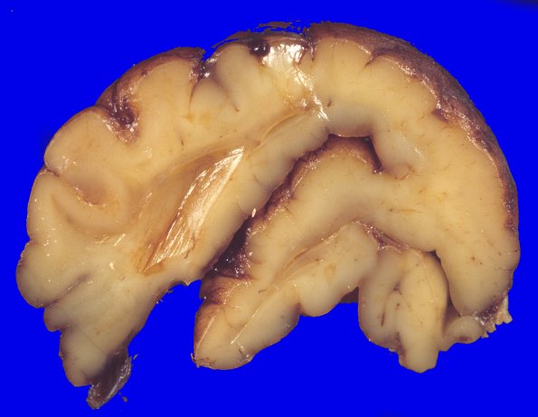 14A3-Encephalocoele-Case-14-1