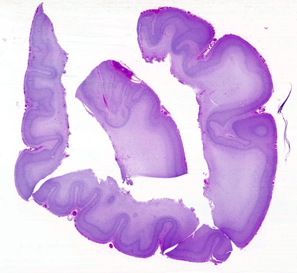 14B1-Encephalocele-Case-14-H-E-3-whole-mount