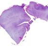 14B2 Encephalocele (Case 14) H&E 6