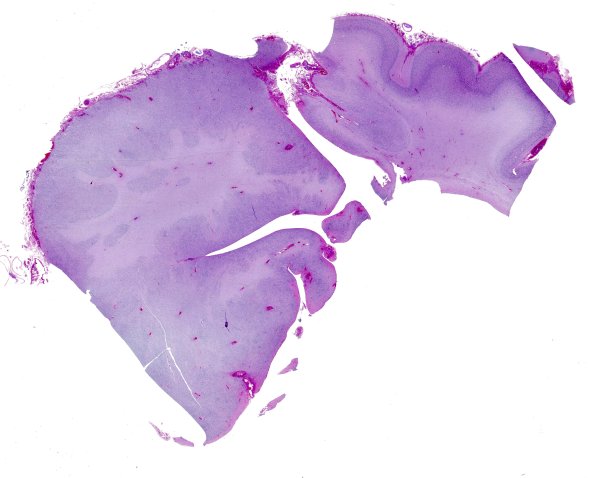 14B2-Encephalocele-Case-14-H-E-6