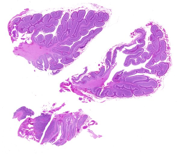 14C1-Encephalocele-Case-14-H-E-whole-mount-1