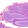 14C2-Encephalocele-Case-14-H-E-4.jpg