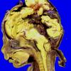 15A1-Encephalocoele-Case-15-1