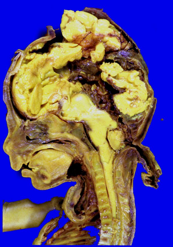 15A1-Encephalocoele-Case-15-1