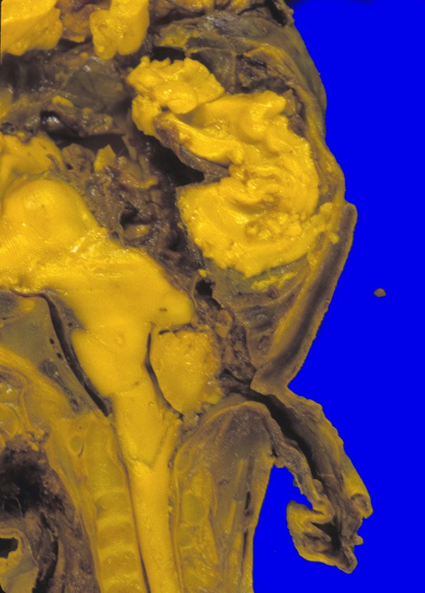 15A2 Encephalocoele (Case 15) 2