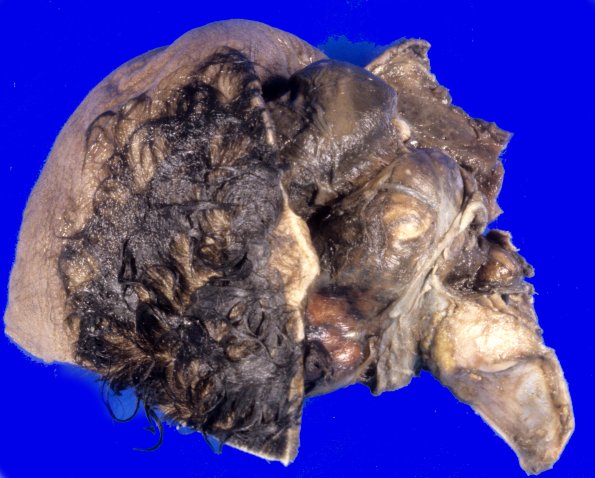 17A1-Encephalocele-Case-17-1