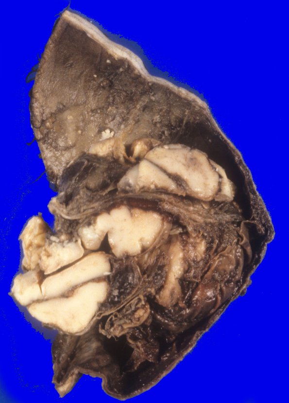 17A2-Encephalocele-Case-17-2