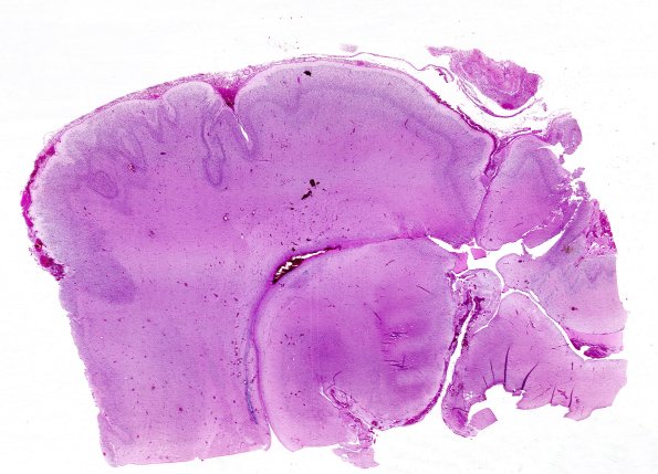 17B1 Polymicrogyria (Case 17) 1, 34 week gestation