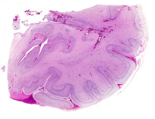 17B2-Polymicrogyria-Case-17-H-E-whole-mount