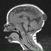 18A Encephalocele (Case 18) T1 without contrast - Copy