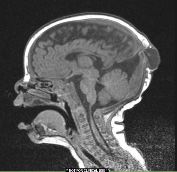 18A Encephalocele (Case 18) T1 without contrast - Copy