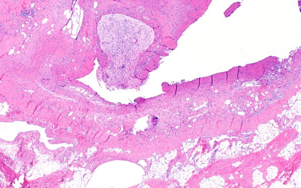 18B Encephalocele (Case 18) Glial island H&E 1