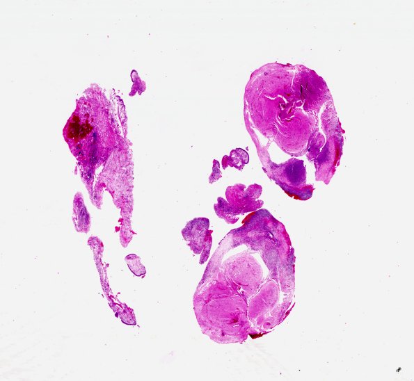 19A1 Encephalocoele (Case 19) with CSF leak H&E 6