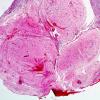 19A2 Encephalocoele (Case 19) with CSF leak H&E 5