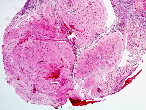 19A2-Encephalocoele-Case-19-with-CSF-leak-H-E-5