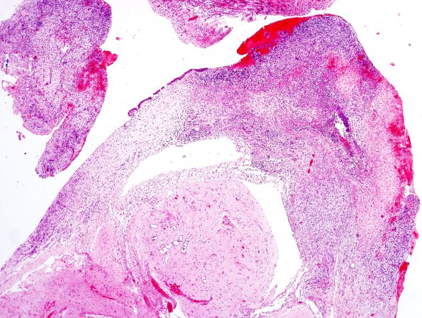 19A3 Encephalocoele (Case 19) with CSF leak H&E 4