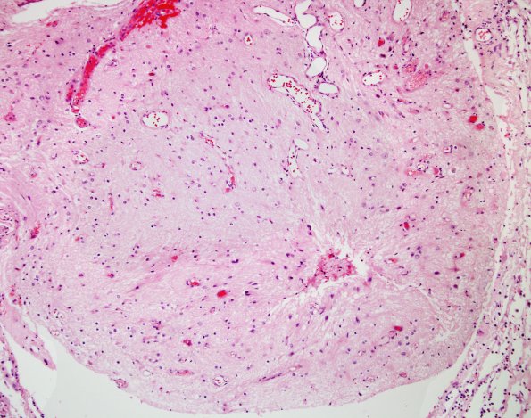 19A4 Encephalocoele (Case 19) with CSF leak H&E 3