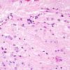 19A5 Encephalocoele (Case 19) with CSF leak H&E 2