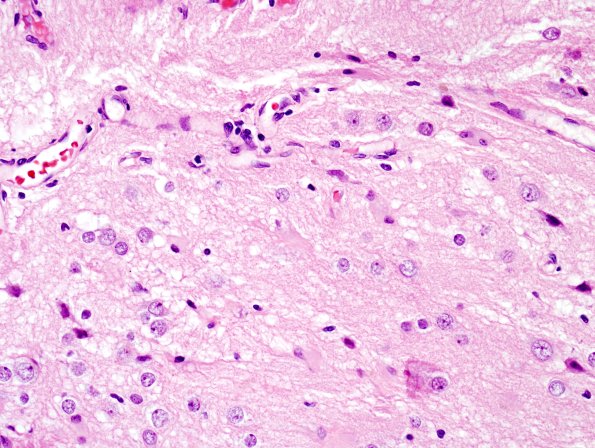 19A5 Encephalocoele (Case 19) with CSF leak H&E 2