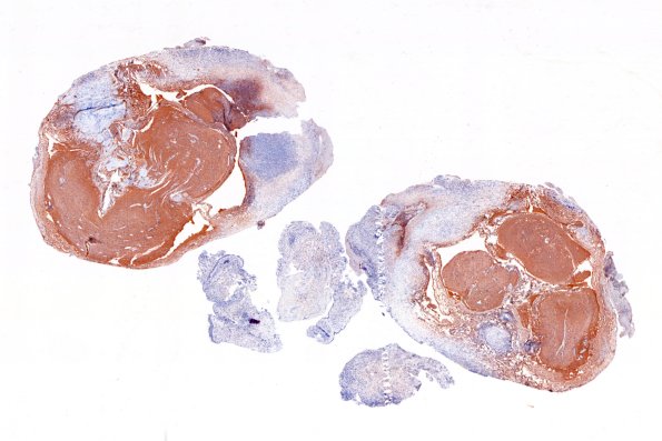 19B-Encephalocoele-Case-19-with-CSF-leak-GFAP