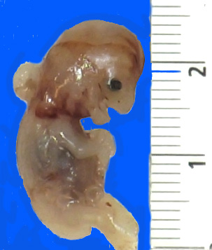 1A1 Myelomeningocele (Case 1)