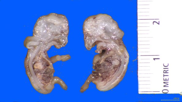 1A2 Myelomeningocele (Case 1) Gross 8 weeks gestation_4 a