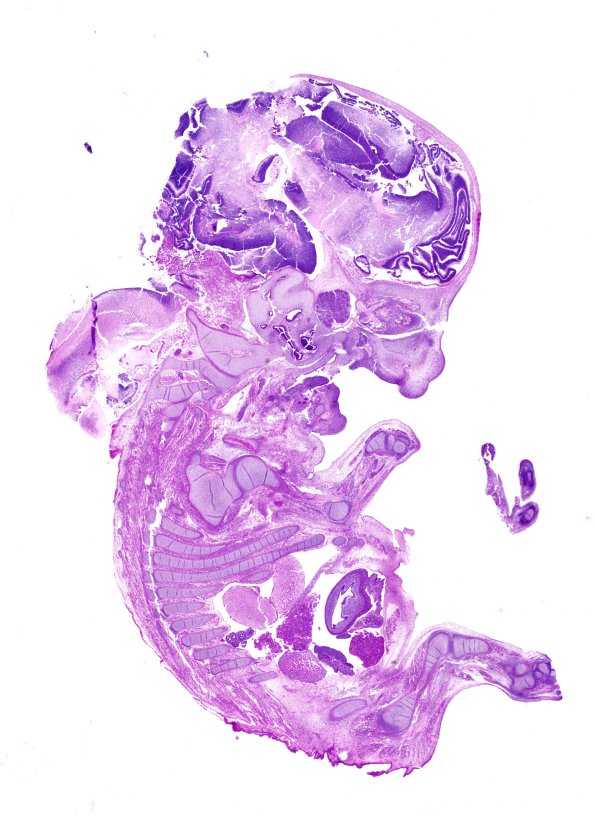 1B1 Myelomeningocele (Case 1) H&E WM