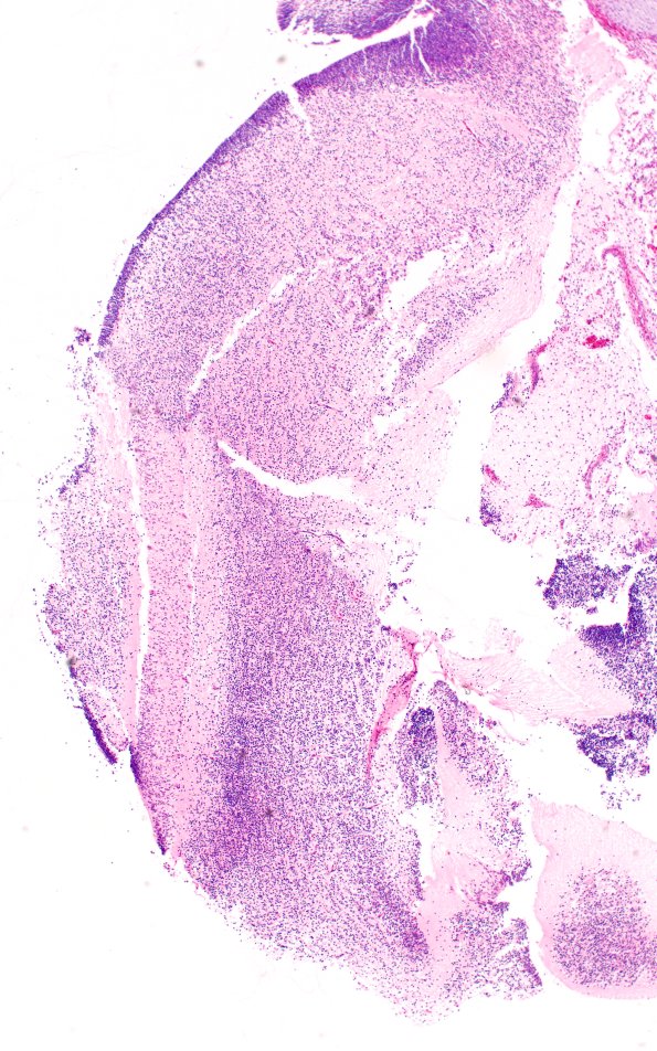 1B3 Myelomeningocele (Case 1) H&E 4X 2