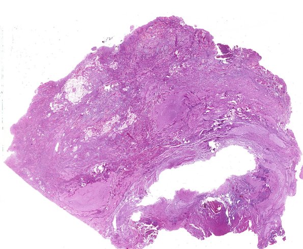 21A1 Encephalocoele (Case 21) H&E whole mount