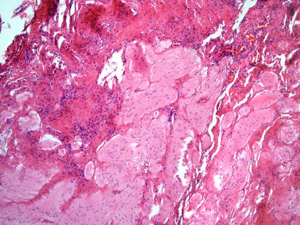 21A2 Encephalocoele (Case 21) H&E 2