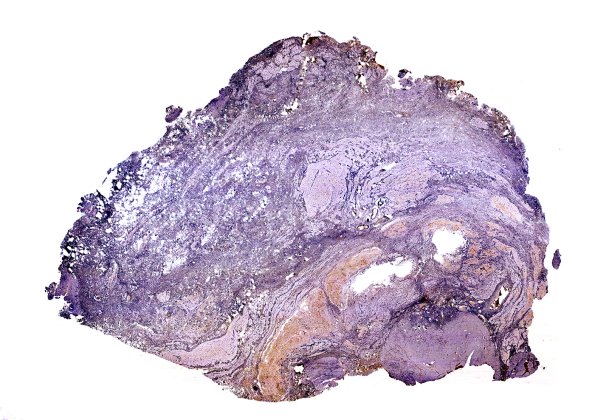 21B1 Encephalocoele (Case 21) NeuN