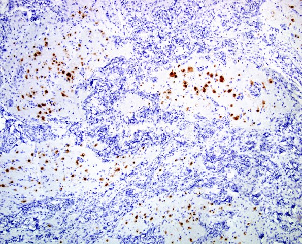 21B2 Encephalocoele (Case 21) NeuN 3