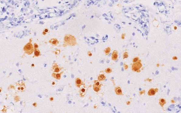 21B3 Encephalocoele (Case 21) NeuN 40X