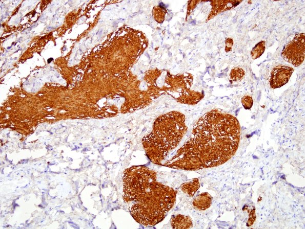 21C3 Encephalocoele (Case 21) GFAP 2