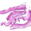 22A1 Encephalocoele & (Case 22) H&E WM