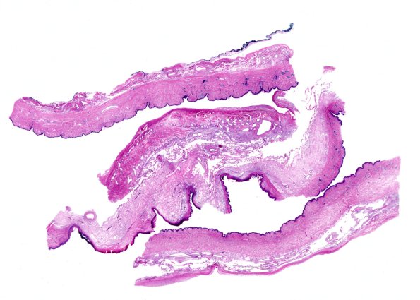 22A1 Encephalocoele & (Case 22) H&E WM