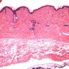 22A2 Encephalocoele & (Case 22) H&E 3