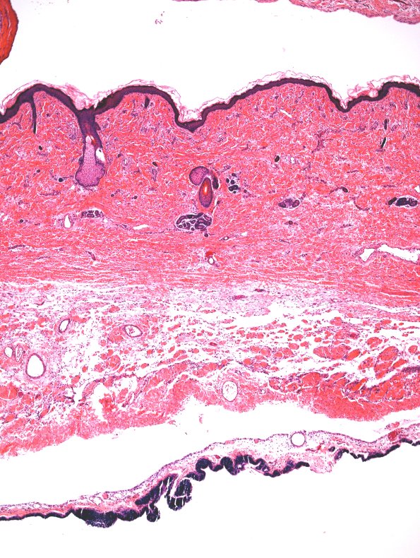 22A2-Encephalocoele-Case-22-H-E-3