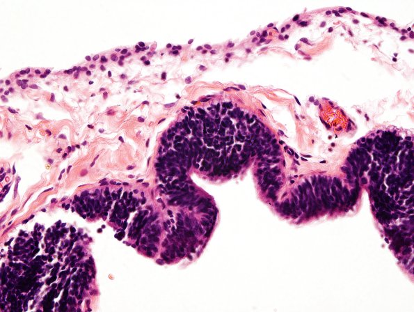 22A3 Encephalocoele & (Case 22) H&E