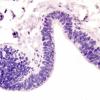 22A4 Encephalocoele & (Case 22) Neg Control