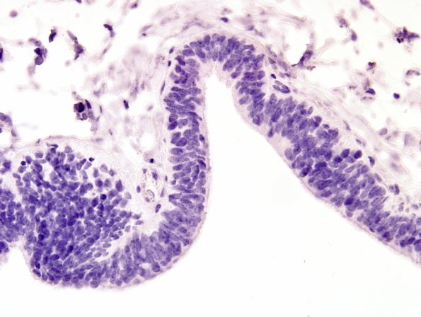 22A4-Encephalocoele-Case-22-Neg-Control