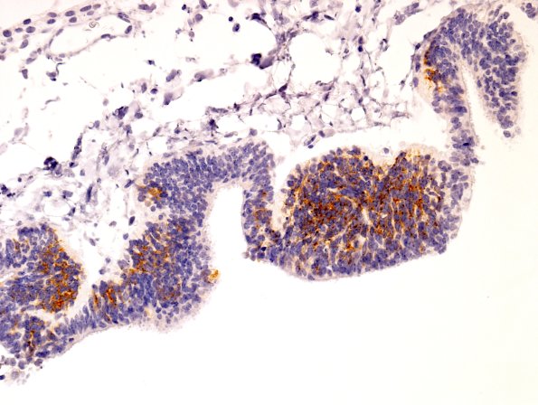 22B-Encephalocoele-Case-22-SYN