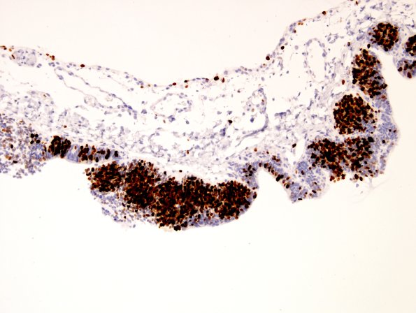 22C Encephalocoele & (Case 22) MIB