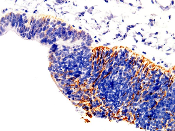 22D-Encephalocoele-Case-22-GFAP