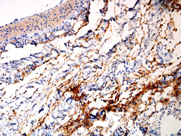 22E Encephalocoele & (Case 22 EMA