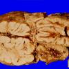 24B Encephalocoele (Case 24) 1