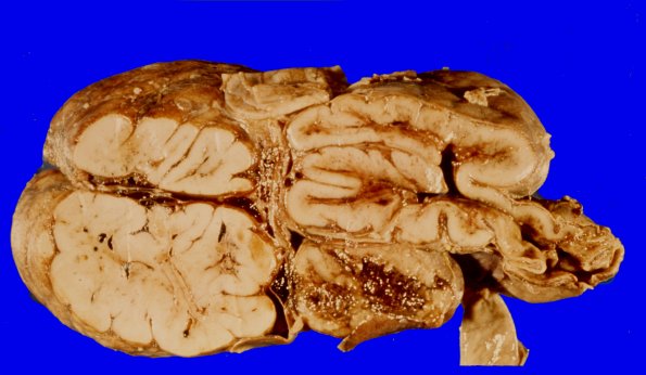 24B Encephalocoele (Case 24) 1