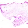 25B1-Encephalocoele-Case-25-H-E-WM-2-copy